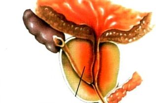 Kaj je prostatitis pri moških