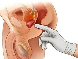Masaža prostate za zdravljenje prostatitisa pri moških