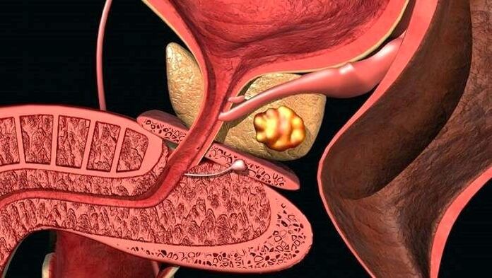 Kamni v prostati s kalkuloznim prostatitisom
