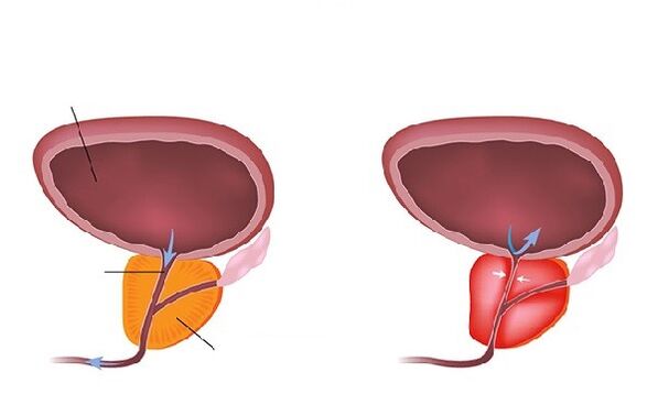 normalna in vneta prostata