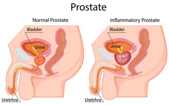 zdrava in vneta prostata
