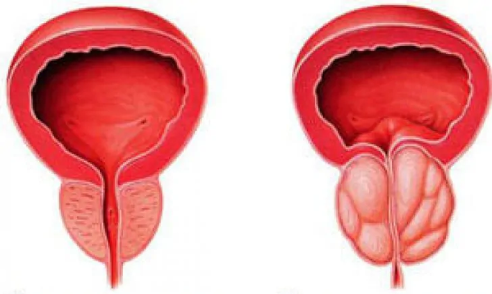 Normalna prostata (levo) in vnetni kronični prostatitis (desno)