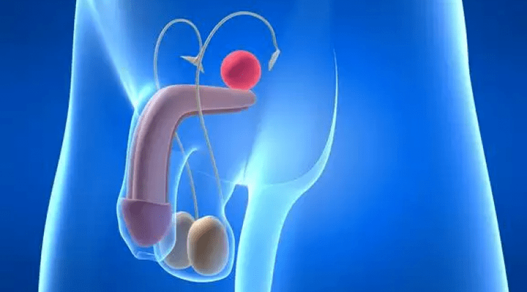 Prostatitis je vnetje prostate pri moških, ki zahteva kompleksno zdravljenje